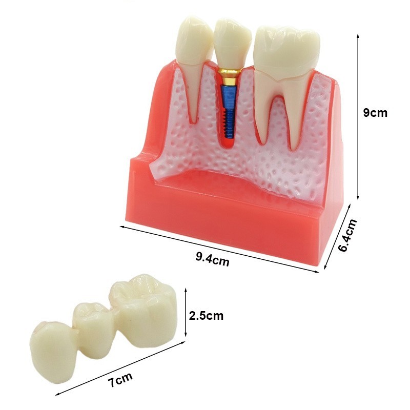 4 Times Dental Implant Analysis Crown Bridge Demonstration Study Teeth Model