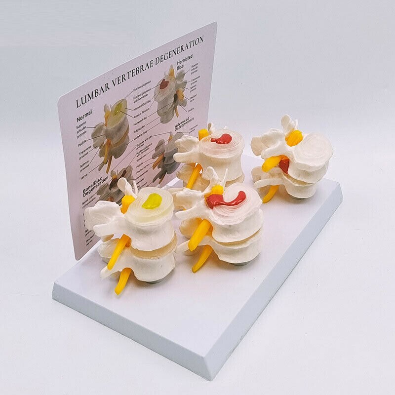 Sick Human Lumbar Vertebrae Degenerative Disc Disease Model Anatomical