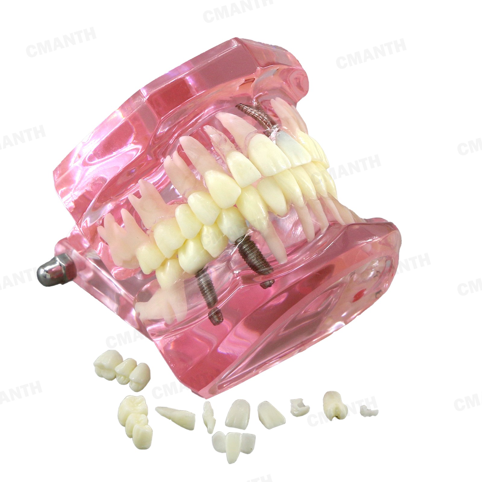 US Dental Teeth Implant Restoration Model Transparent Pathological Study Demo