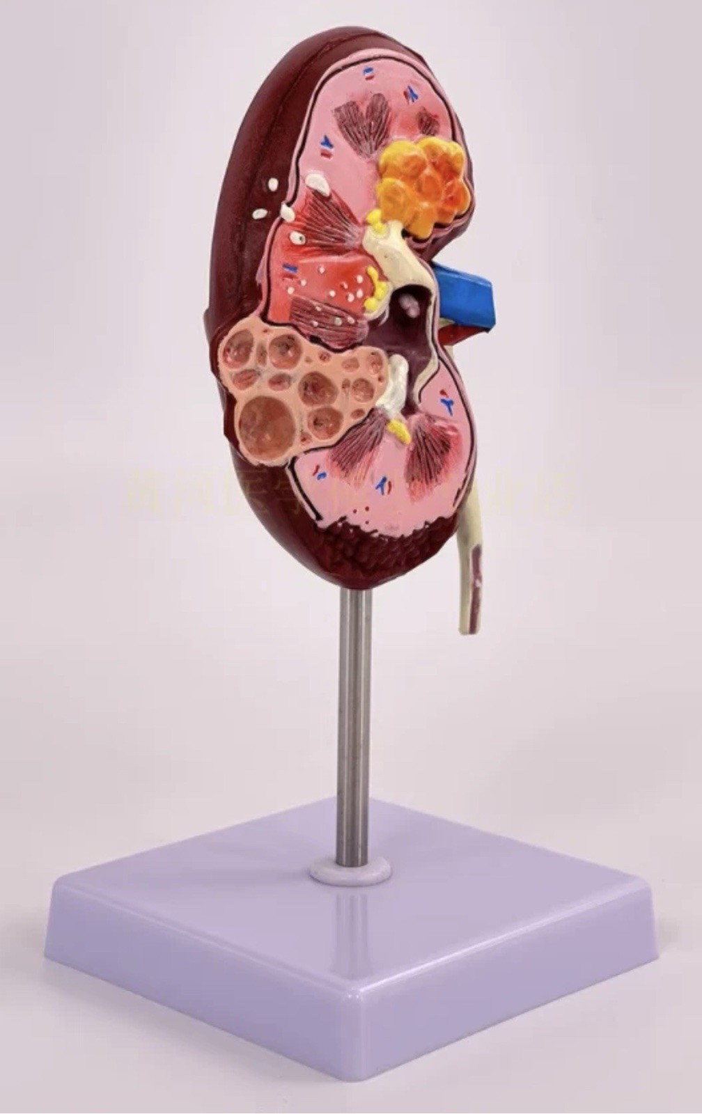 NEW Human Normal/Pathological Kidney Model Anatomy Medical Teaching Model