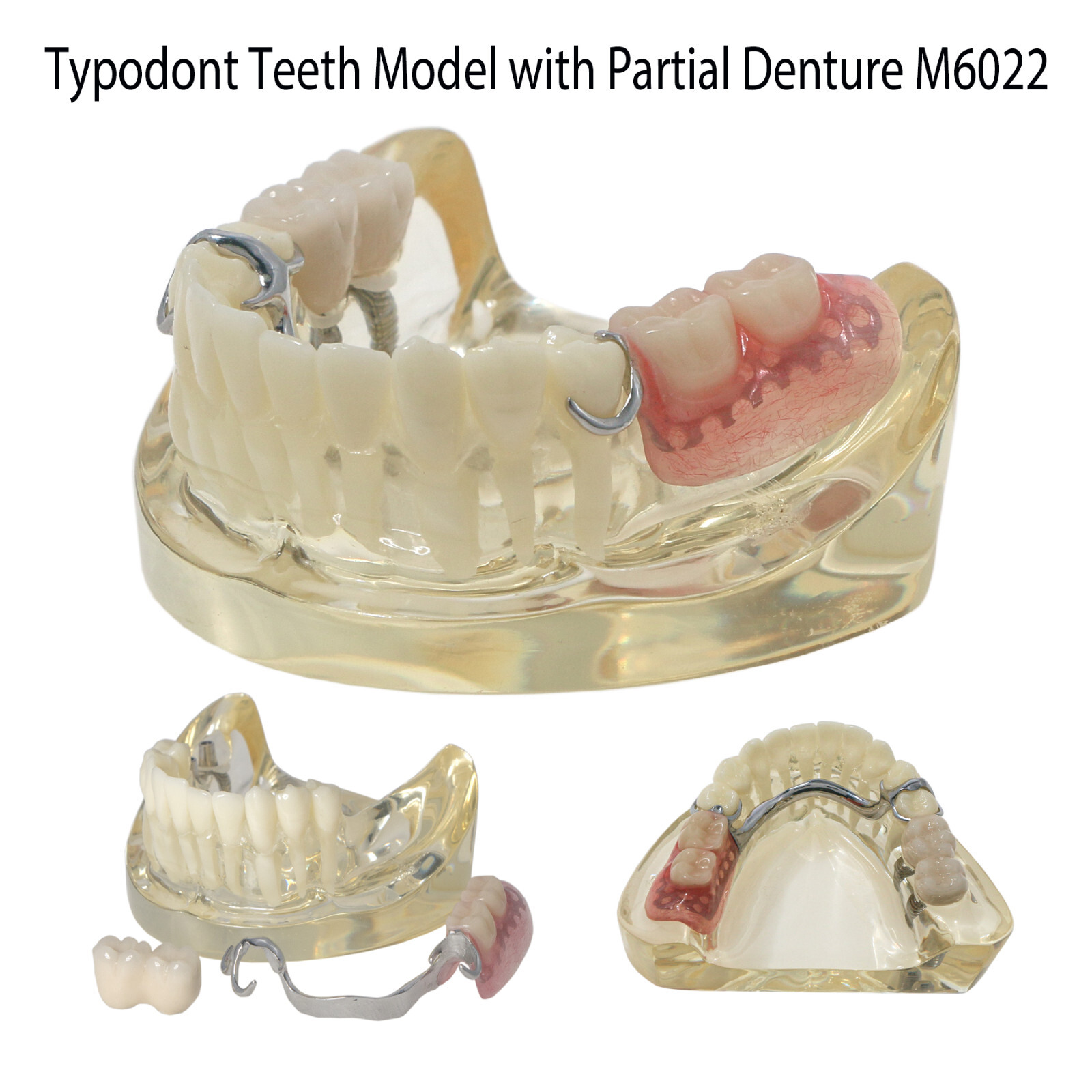 Dental Restoration Implant Typodont Teeth Model with Partial Denture M6022