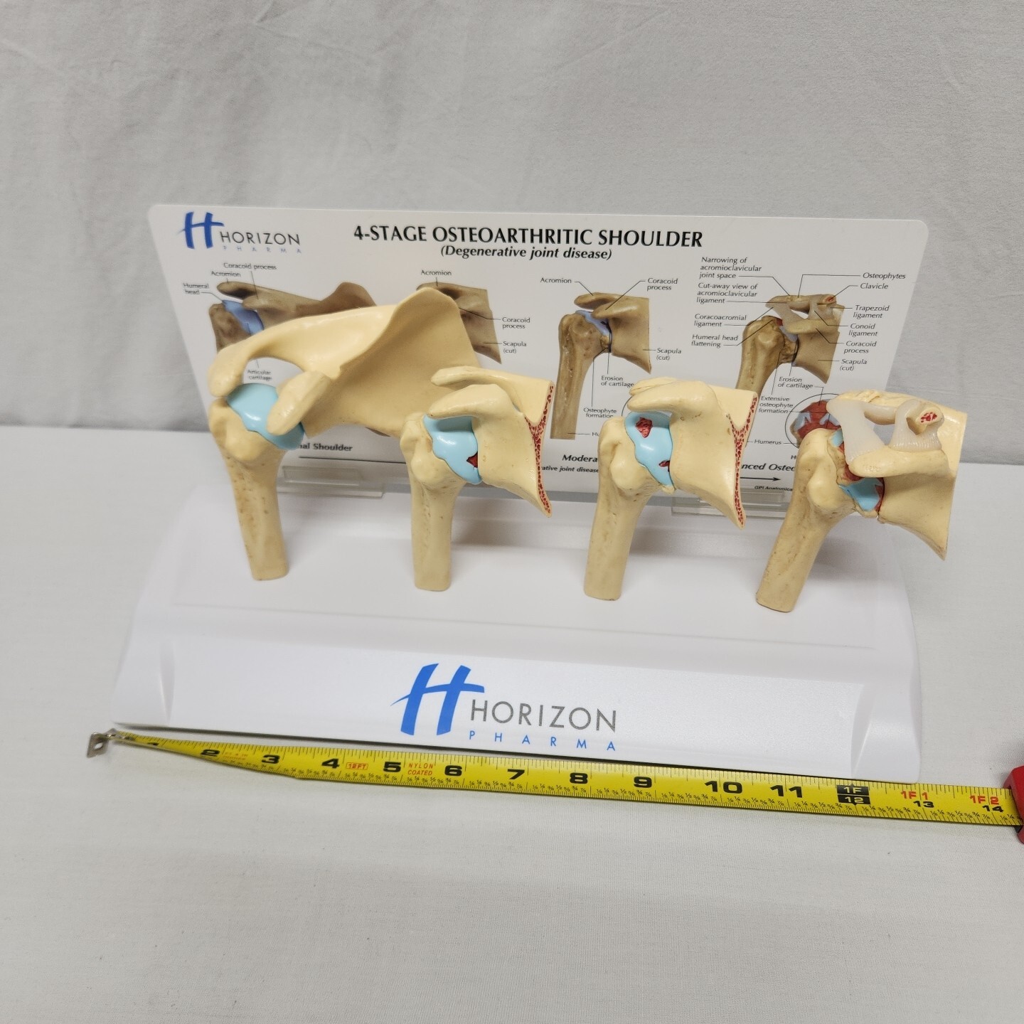 Degenerative Joint Disease 4 Stage Osteoarthritis Osteoarthritic Shoulder Model