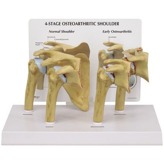 Shoulder Osteoarthritic 4-Stage GPI Anat Model Set LFA#1800 Make OfferSEE VIDEO