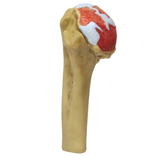 Shoulder Osteoarthritic 4-Stage GPI Anat Model Set LFA#1800 Make OfferSEE VIDEO