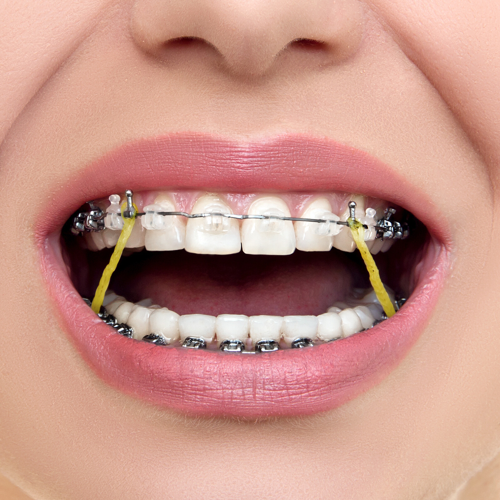 500pcs Dental Orthodontic Rubber Intraoral Elastic Latex Bands 3.5/4.5/6.5 OZ
