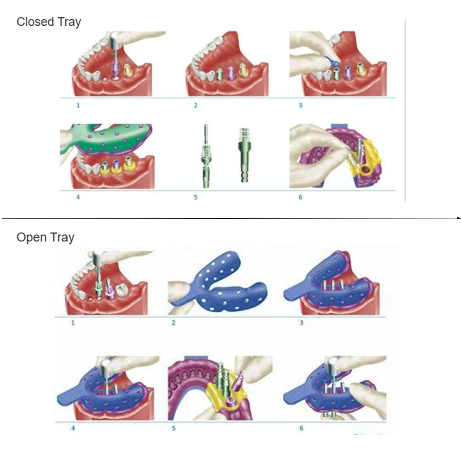 Open Closed Tray Impression Coping Guide Pin For Hiossen ET/OSST TS Mini/Regular
