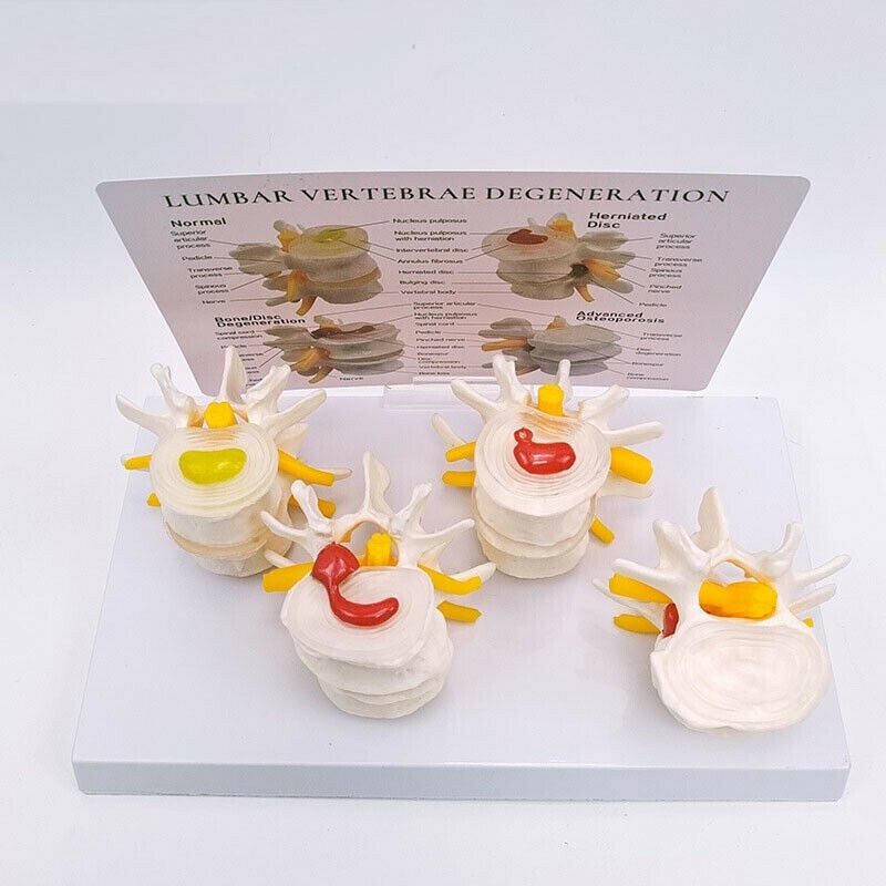 Sick Human Lumbar Vertebrae Degenerative Disc Disease Model Anatomical