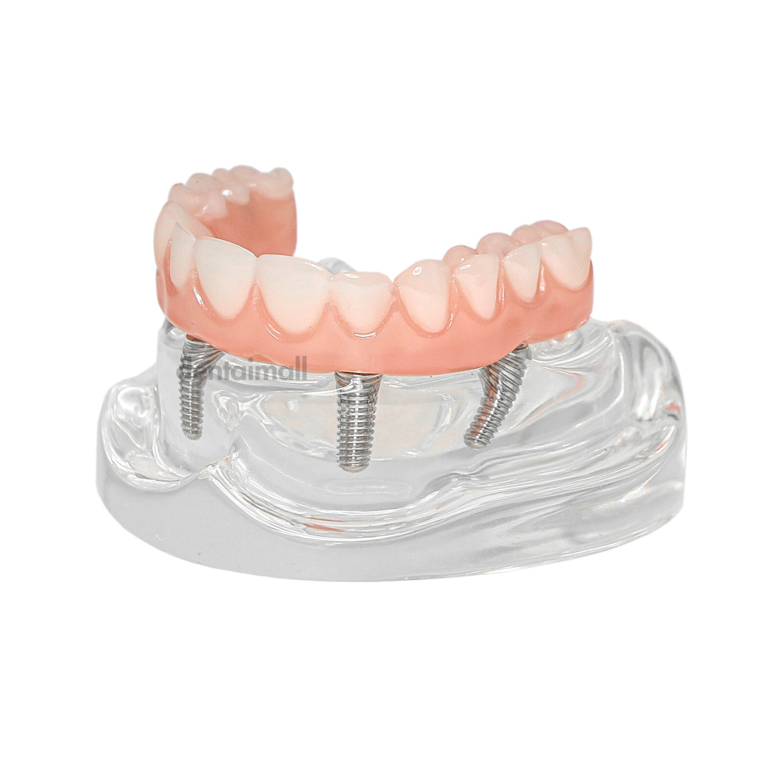 Implant Typodont Teeth Restoration Model Overdenture Practice Demo Series Dental