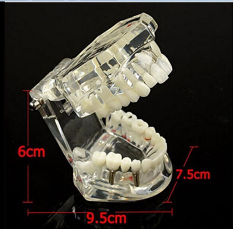 Dental Implant and Restoration Model Transparent Pathological Teeth Study Model
