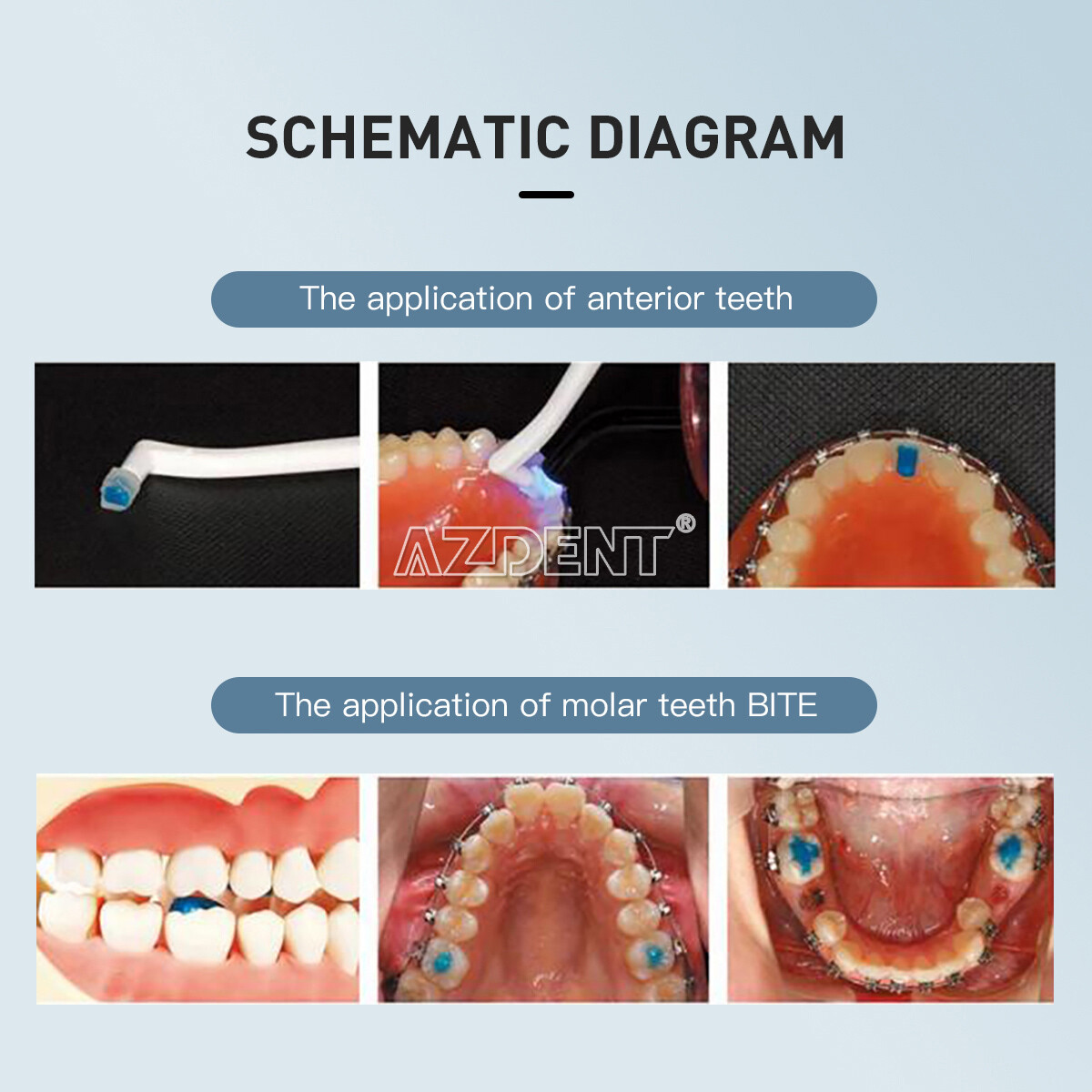 Dental Orthodontic Light Cure Adhesive No-mix Resin Paste Direct Bonding System