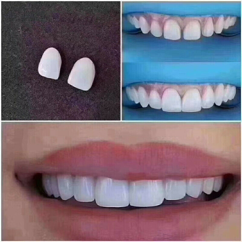 Dental Composite Porcelain Veneers Resin Light Cure Anterior Teeth Whiten Veneer