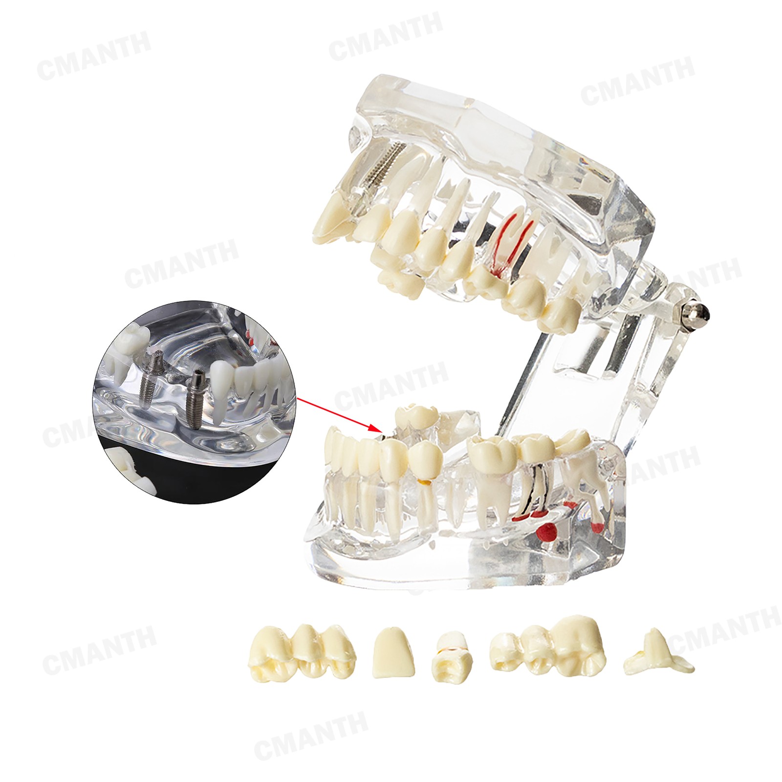 US Dental Teeth Implant Restoration Model Transparent Pathological Study Demo