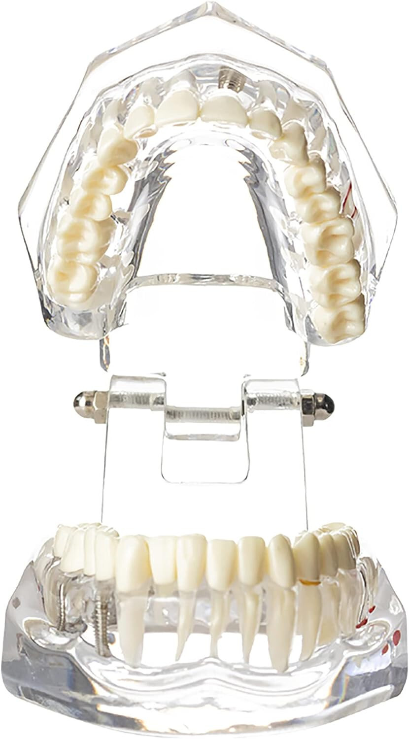 Dental Oral Typodont Model Implant Pathological Removable Teach Visible Anatomy