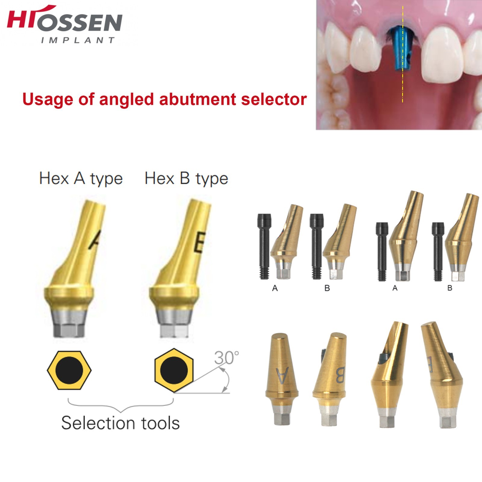 US 17° Dental Angled Anatomic Abutment Hiossen/Osstem TS Mini/Regular Platform