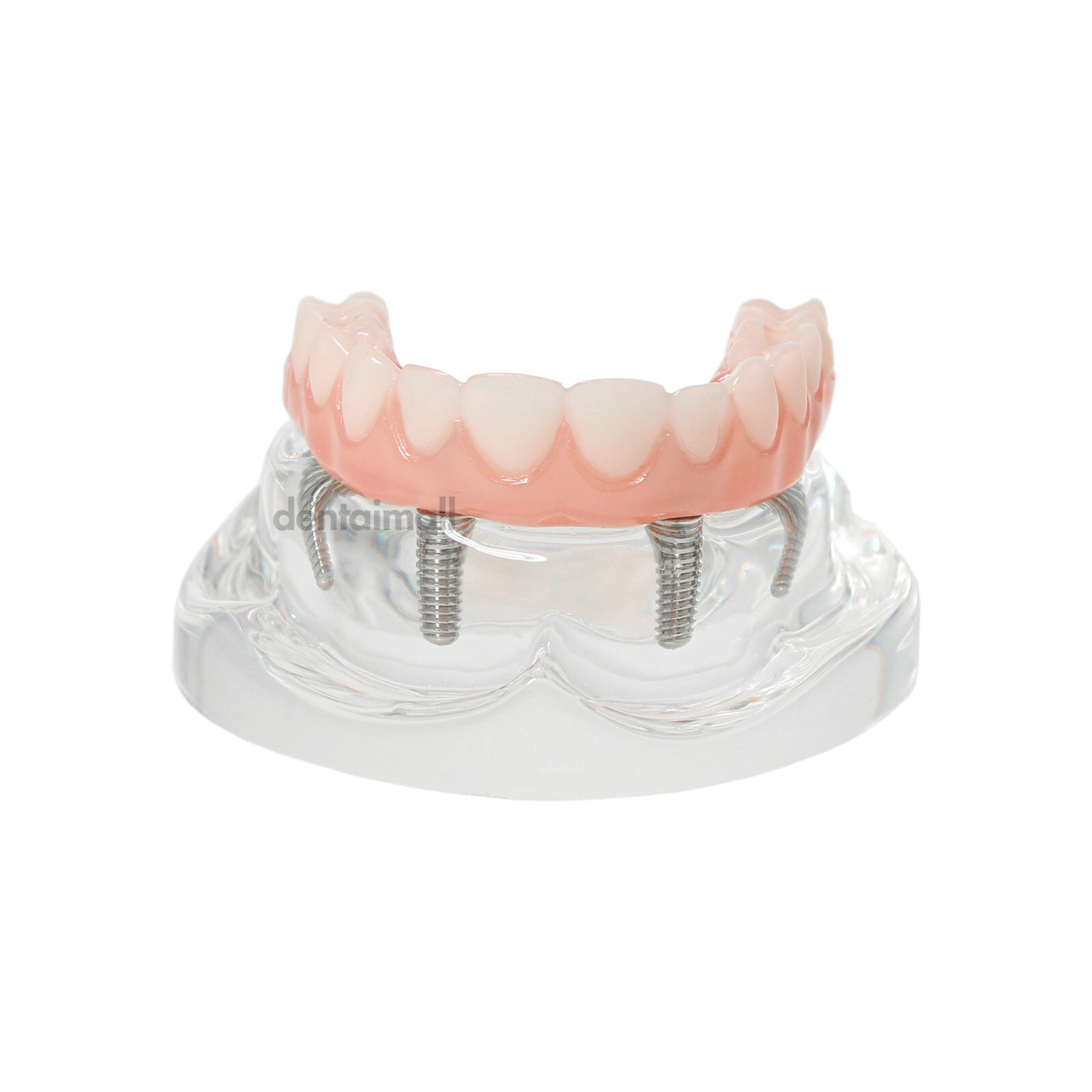 Dental 4 Implants Upper&Lower Demo Implant Teeth Model Restoration Overdenture