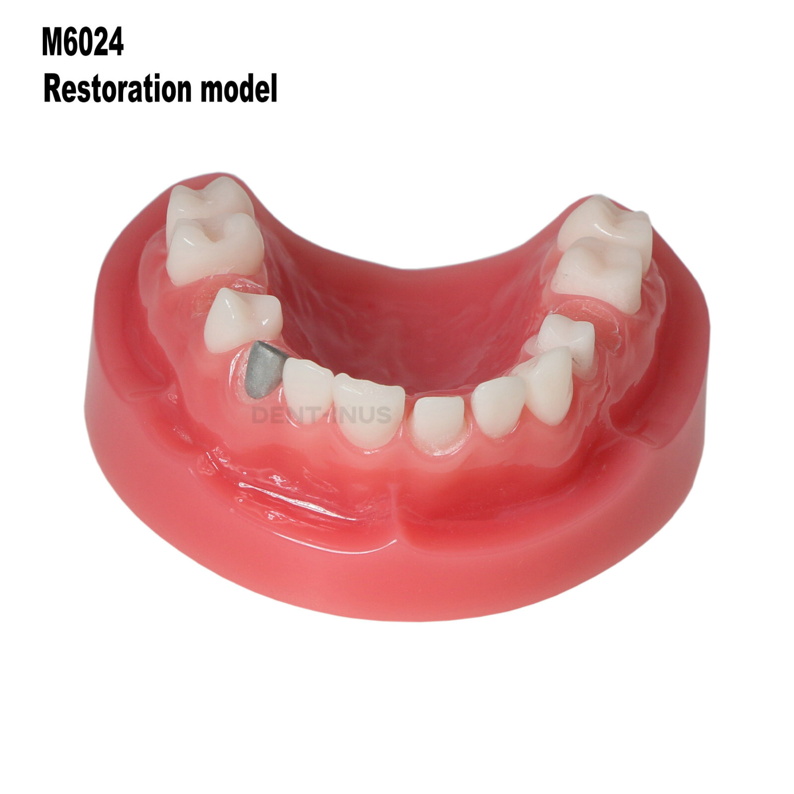 Implant Typodont Teeth Restoration Model Overdenture Practice Demo Series Dental