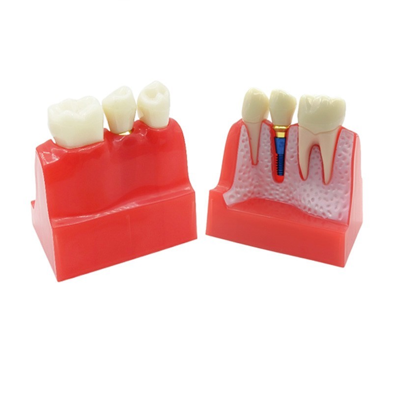 4 Times Dental Implant Analysis Crown Bridge Demonstration Study Teeth Model
