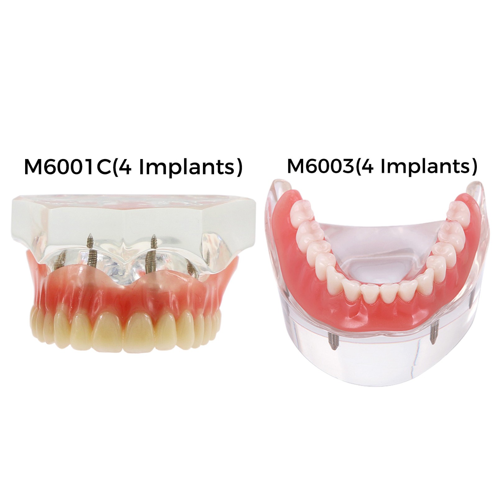 Dental Teeth Model 2 4 Implant Overdenture Typodont Restoration Demo Upper Lower