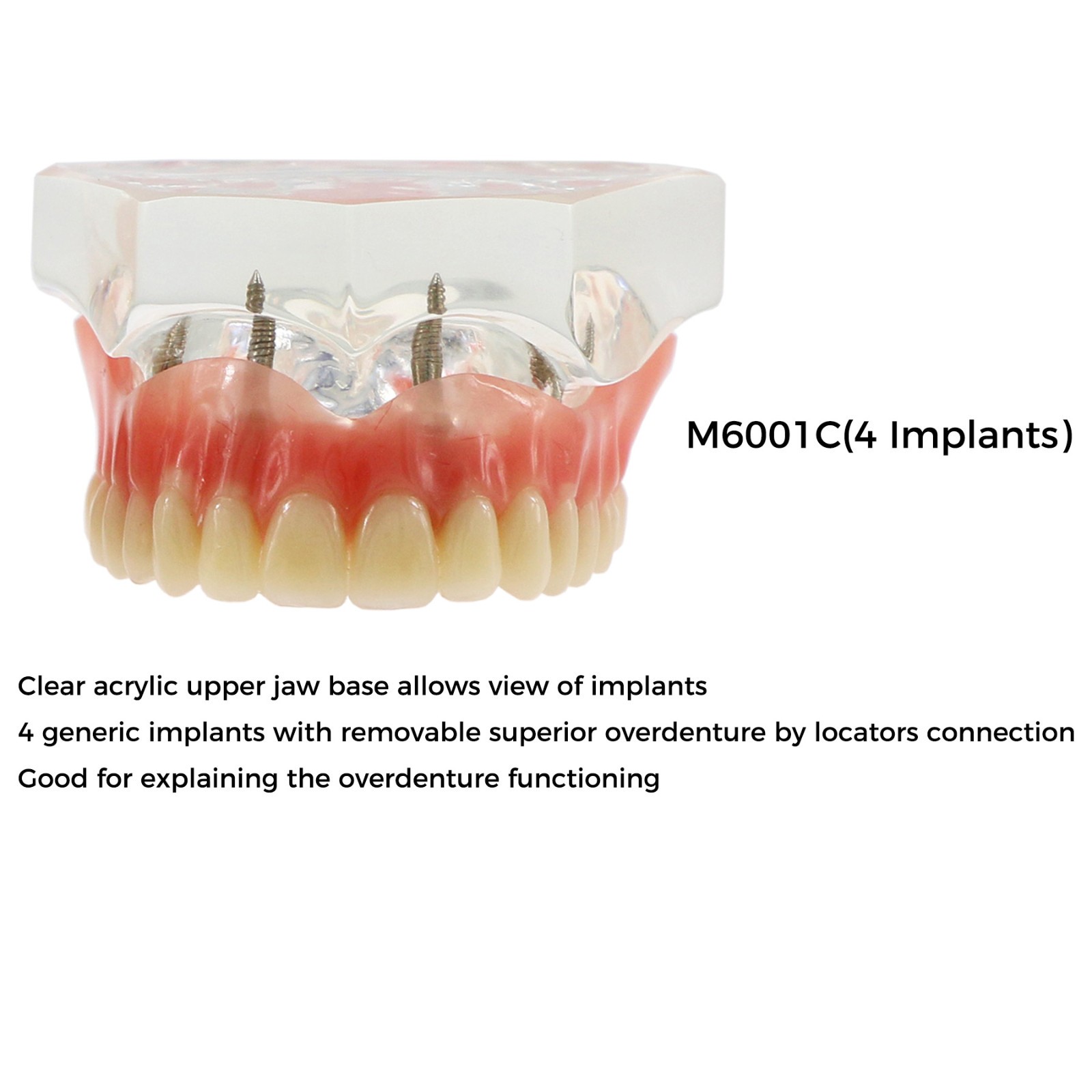 Dental Teeth Model 2 4 Implant Overdenture Typodont Restoration Demo Upper Lower
