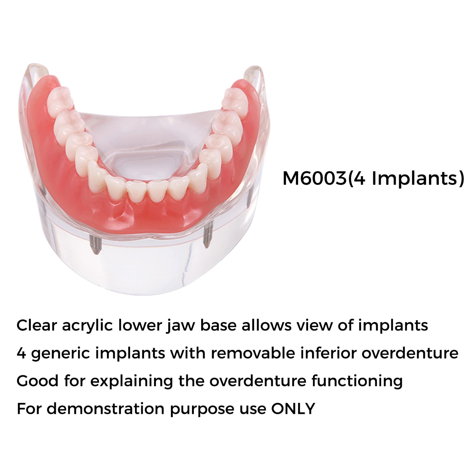 Dental Teeth Model 2 4 Implant Overdenture Typodont Restoration Demo Upper Lower