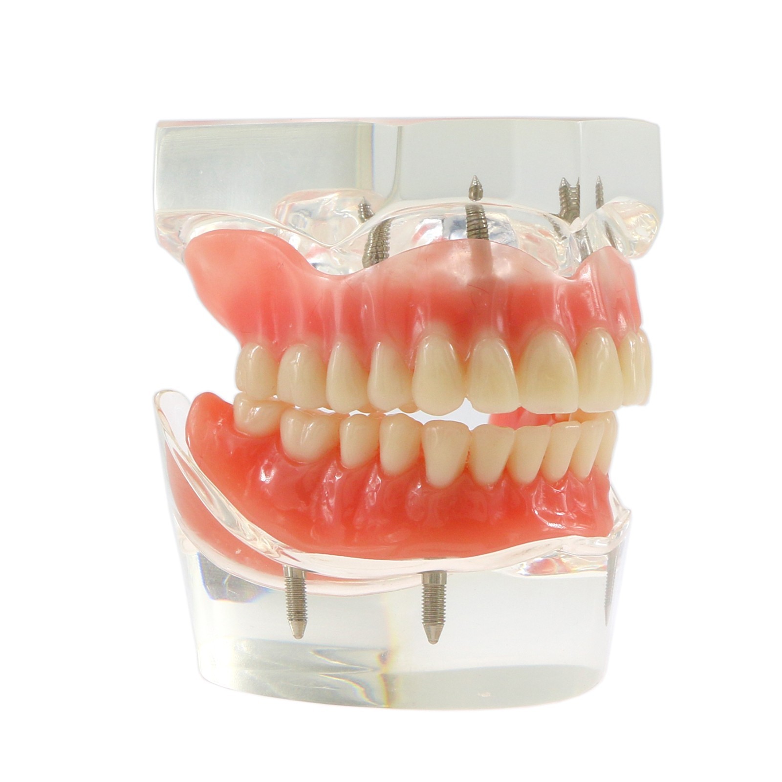 Dental Implant Overdenture Model Upper Lower Jaw Teeth Model with 2/4/6 Screws