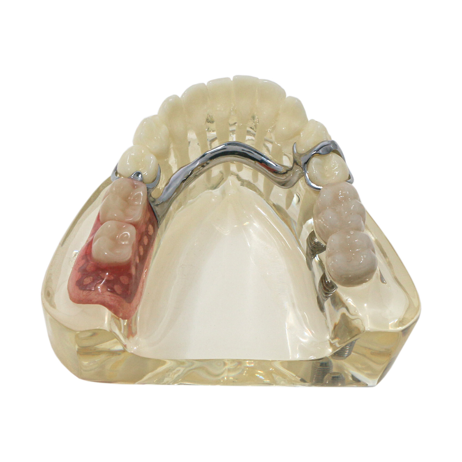 Implant Typodont Teeth Restoration Model Overdenture Practice Demo Series Dental