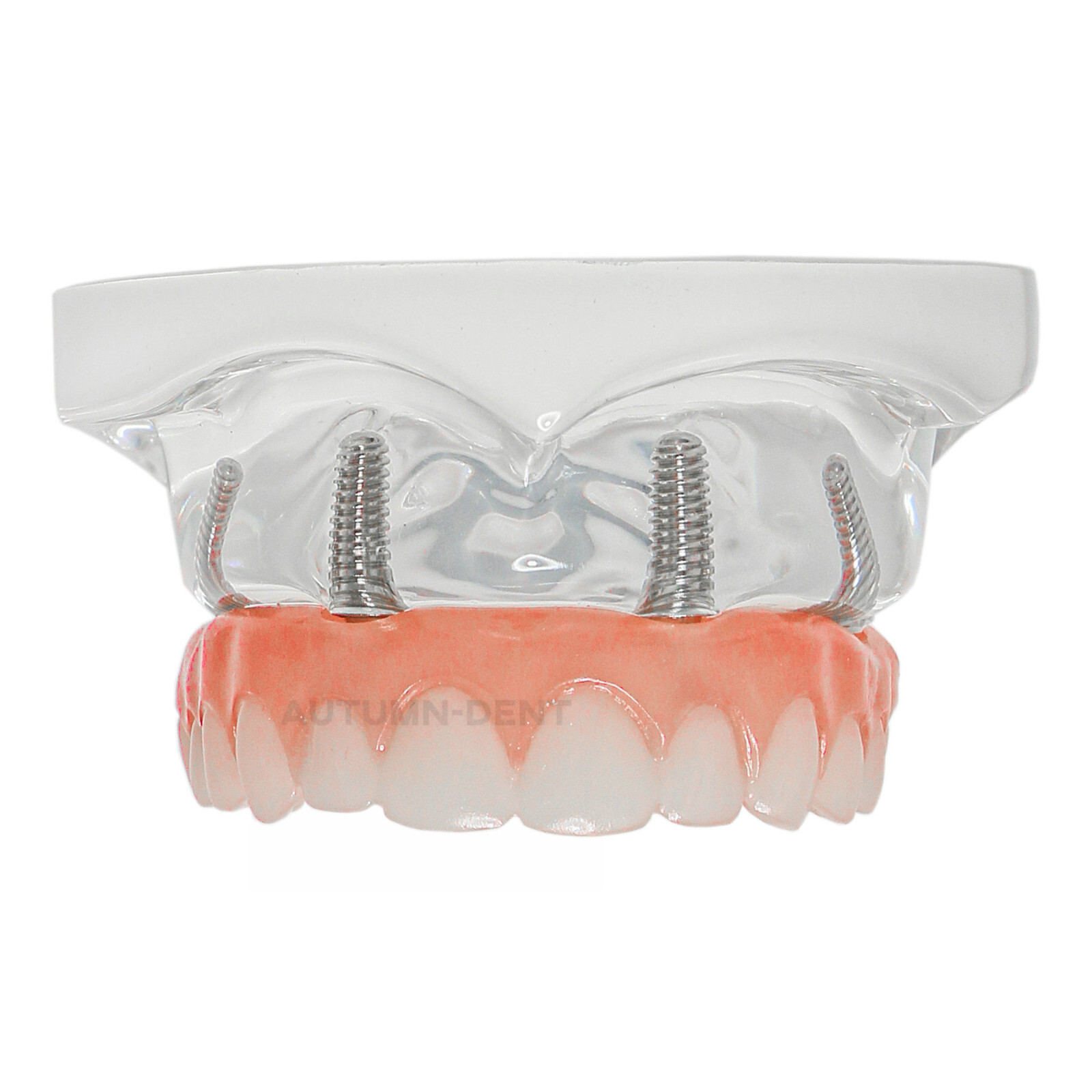Dental 4 Implants Upper&Lower Demo Implant Teeth Model Restoration Overdenture