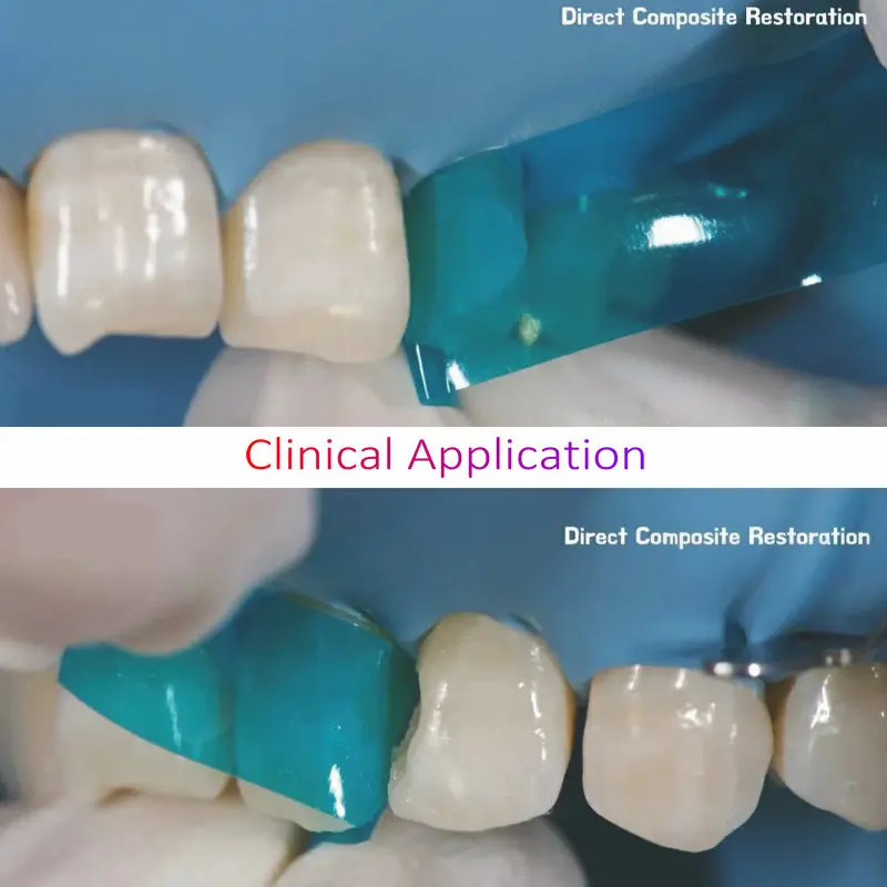 Dental Proximal Anterior Strips Polyester Matrix Bands Clear Matrices Anterior