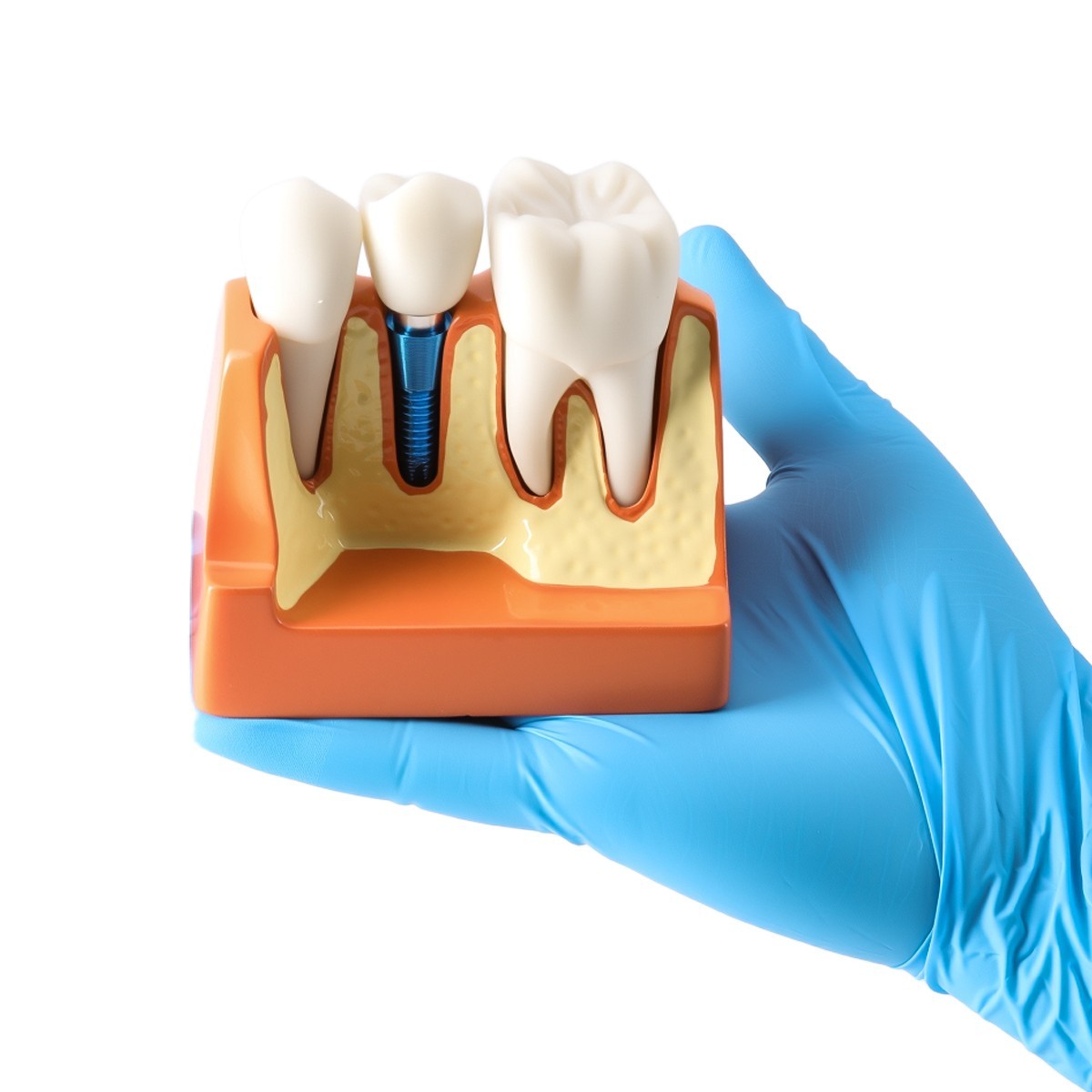 Dental 4 Times Teeth Model Implant Analysis Crown Bridge Demonstration Removable