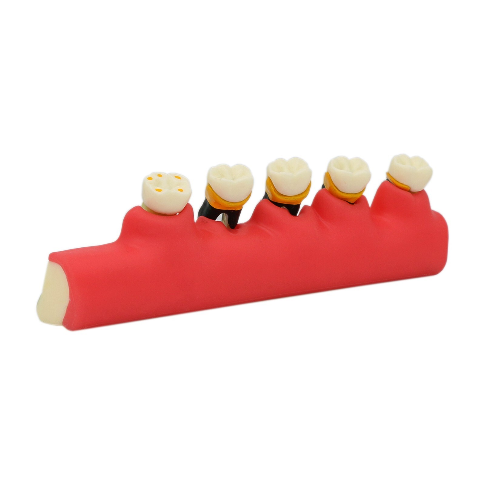 Dental Periodontics Disease 5-Stage Teeth Model Perio Disease Assort Demo Model