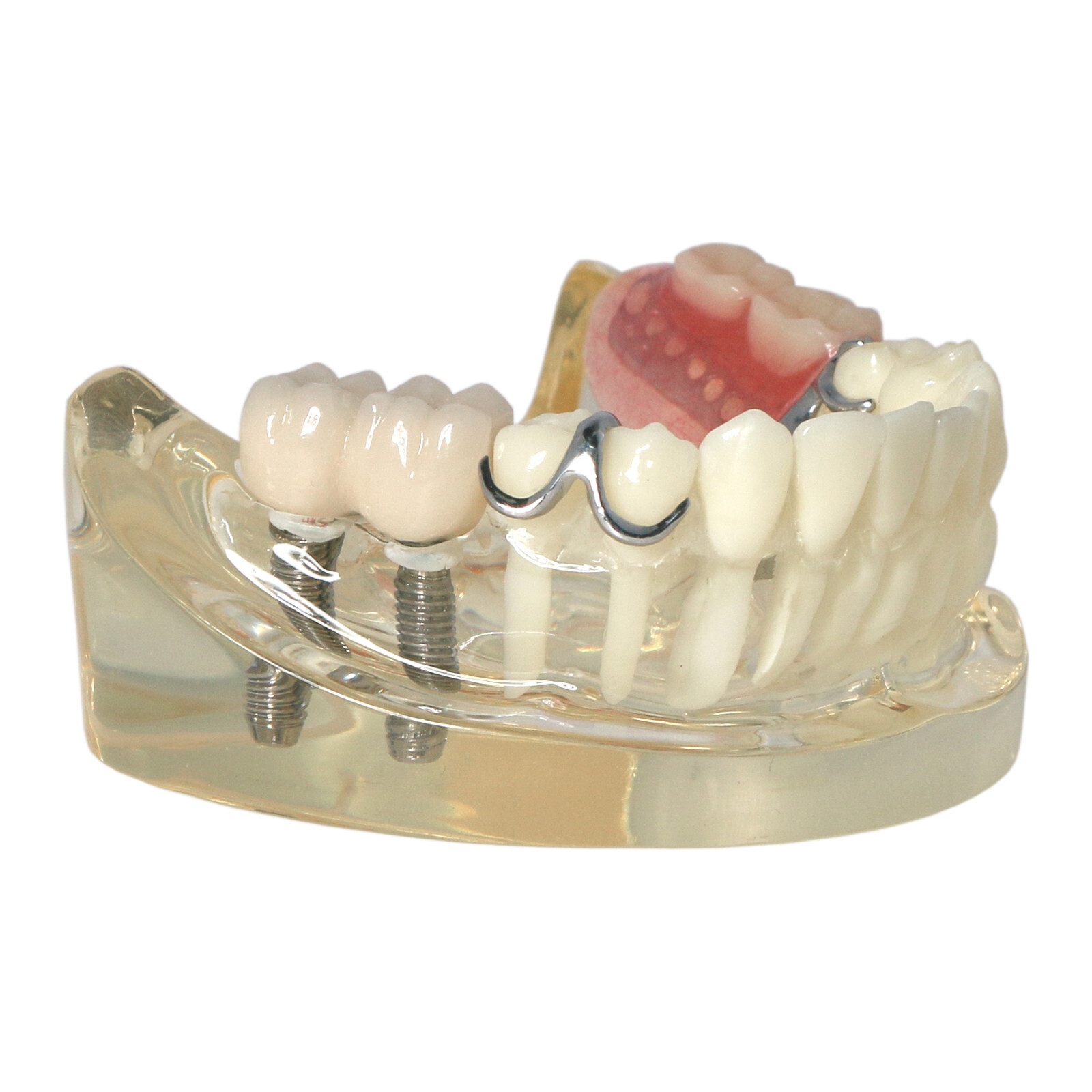 Dental Restoration Implant Typodont Teeth Model with Partial Denture M6022