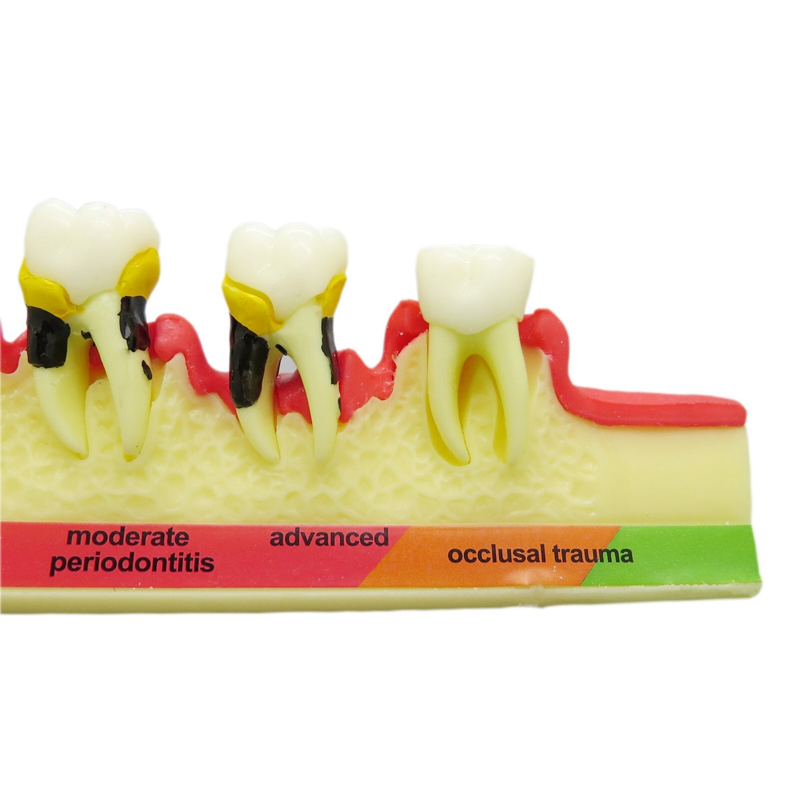 Dental Periodontics Disease 5-Stage Teeth Model Perio Disease Assort Demo Model
