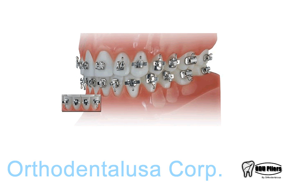 NATURAL ORTHODONTIC BRACKET Stal ALEXANDER SLOT .18 Hook 3/4/5 – 20 pcs 1036-18