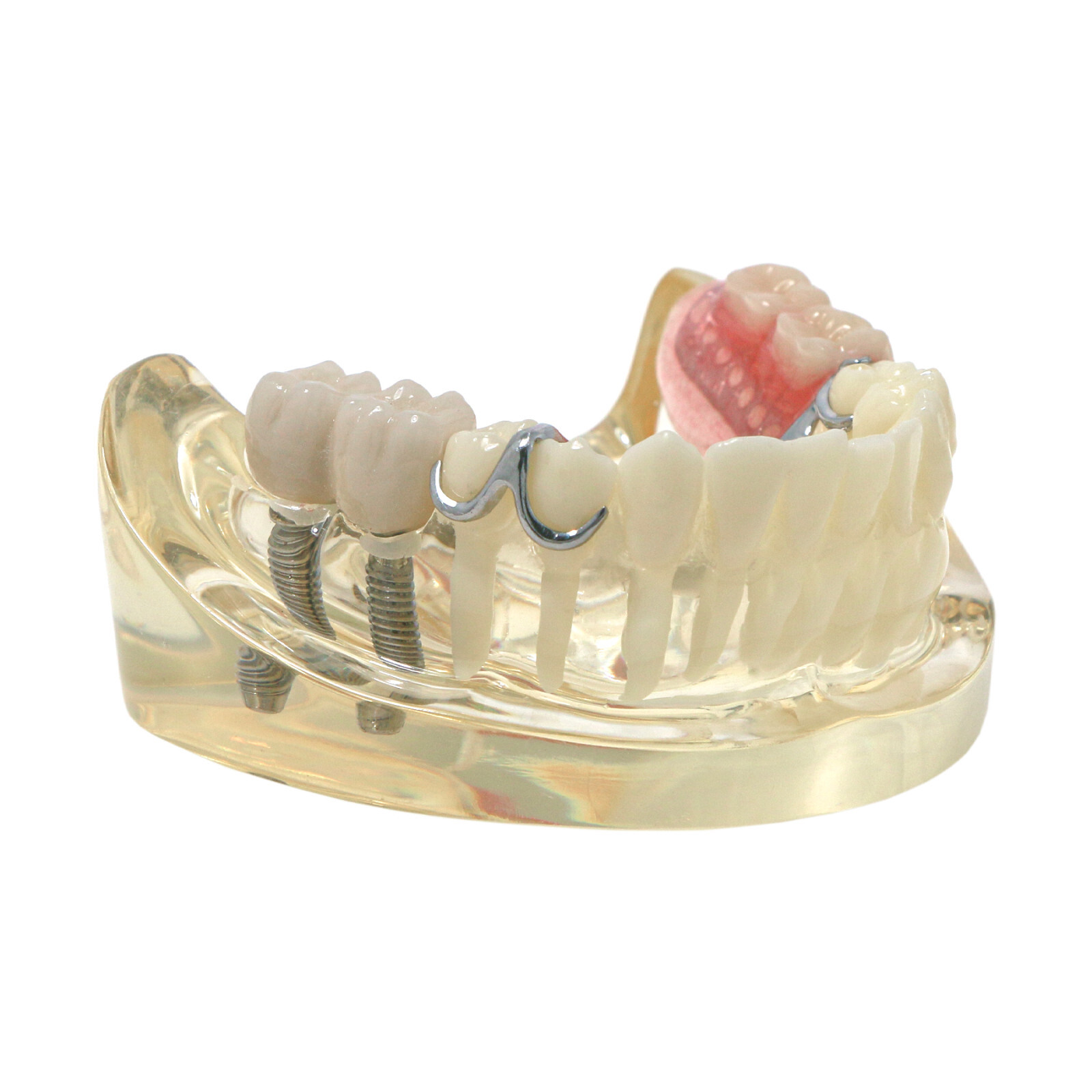 Dental Restoration Implant Typodont Teeth Model with Partial Denture M6022
