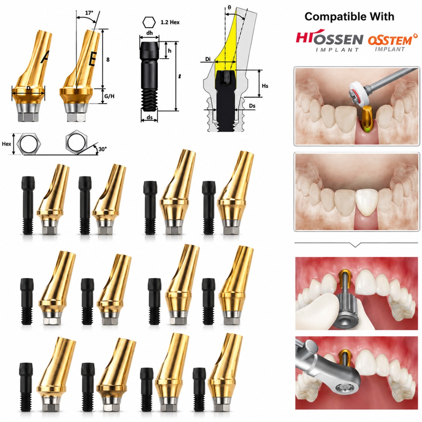 US 5Pcs 17° Angled Anatomic Abutment Hiossen Osstem Mini Regular Hex Titanium