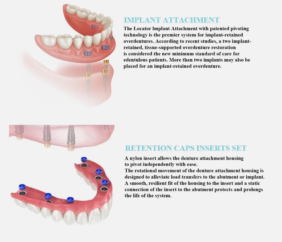 US Zest Locator Abutment Attachment Overdenture Caps Fits Hiossen Nobel Zimmer