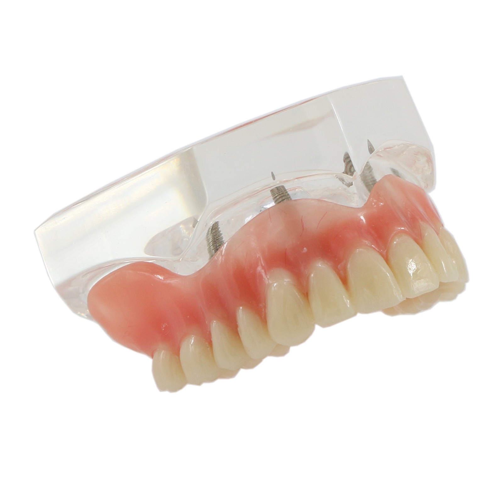 Dental Implant Overdenture Model Upper Lower Jaw Teeth Model with 2/4/6 Screws