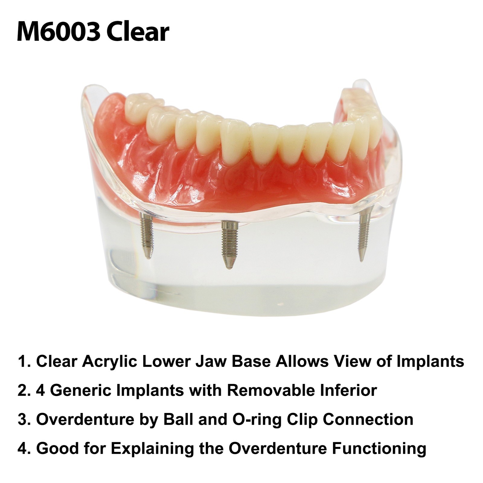 Dental Implant Overdenture Model Upper Lower Jaw Teeth Model with 2/4/6 Screws
