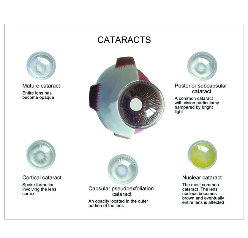 Anatomical Model of Human Cataract and Eye Disease-Medical Pathology Anatomy