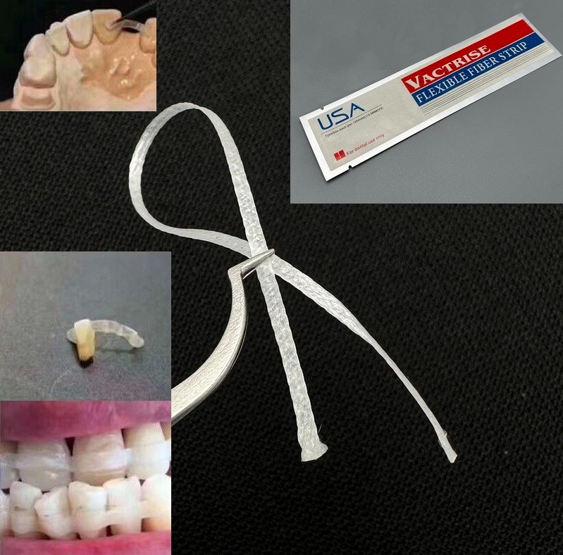 1pcs Dental Glass Fiber Splint Ribbond Ribbon Type Composite Resin Bonding Strip