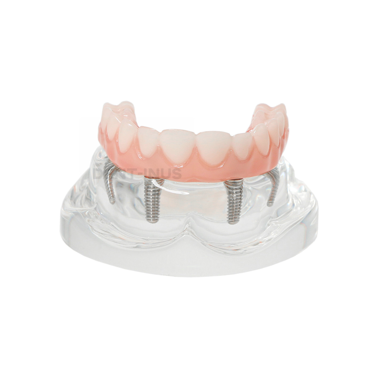 Dental 4 Implants Demo Implant Teeth Model Restoration Overdenture Upper/Lower