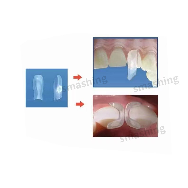 Dental Clear Matrix Anterior Matrices Bow BT Fits Bioclear L/M/S Mixed Sizes 1.9