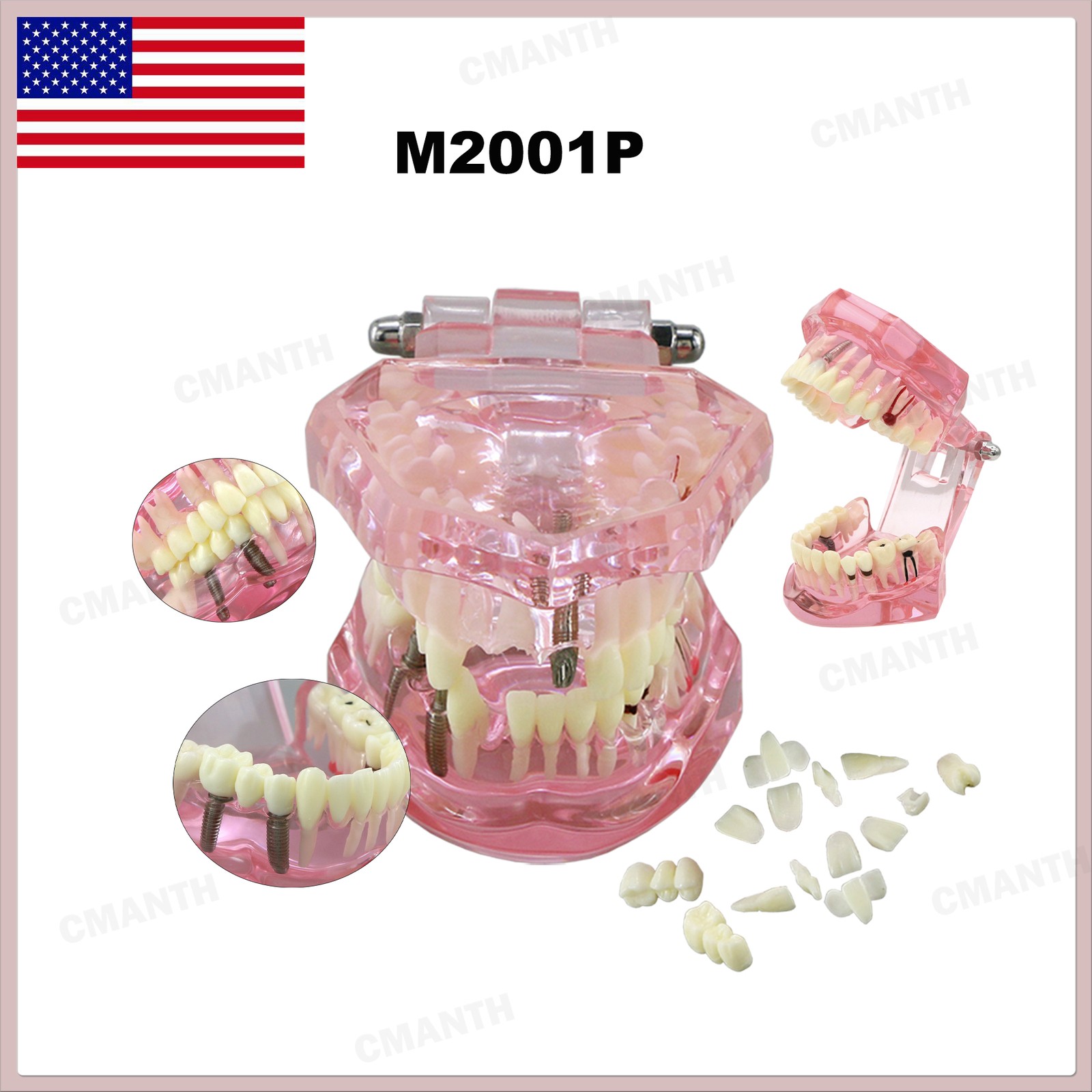 US Dental Teeth Implant Restoration Model Transparent Pathological Study Demo