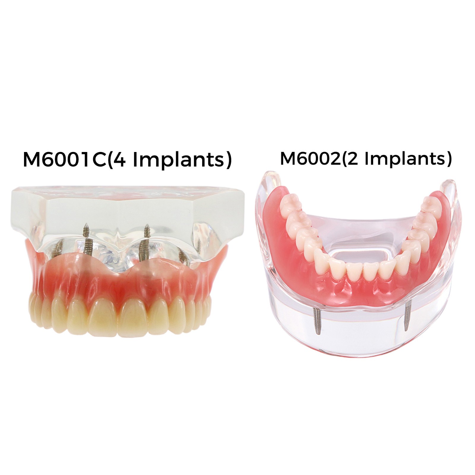 Dental Teeth Model 2 4 Implant Overdenture Typodont Restoration Demo Upper Lower