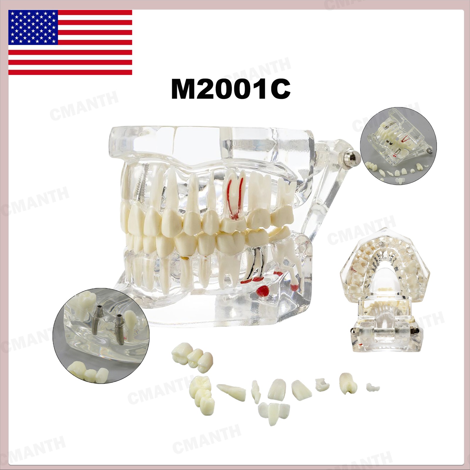 US Dental Teeth Implant Restoration Model Transparent Pathological Study Demo