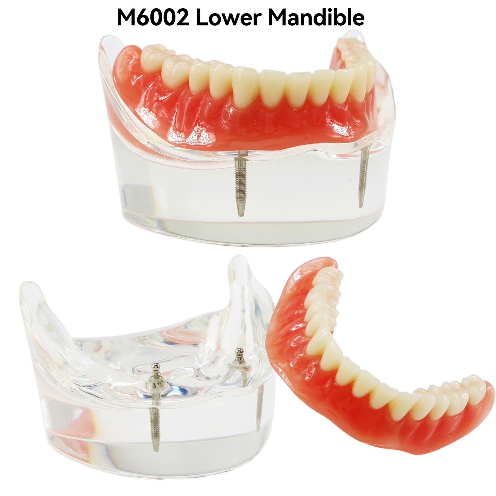 Dental Teeth Model 2 4 Implant Overdenture Typodont Restoration Demo Upper Lower