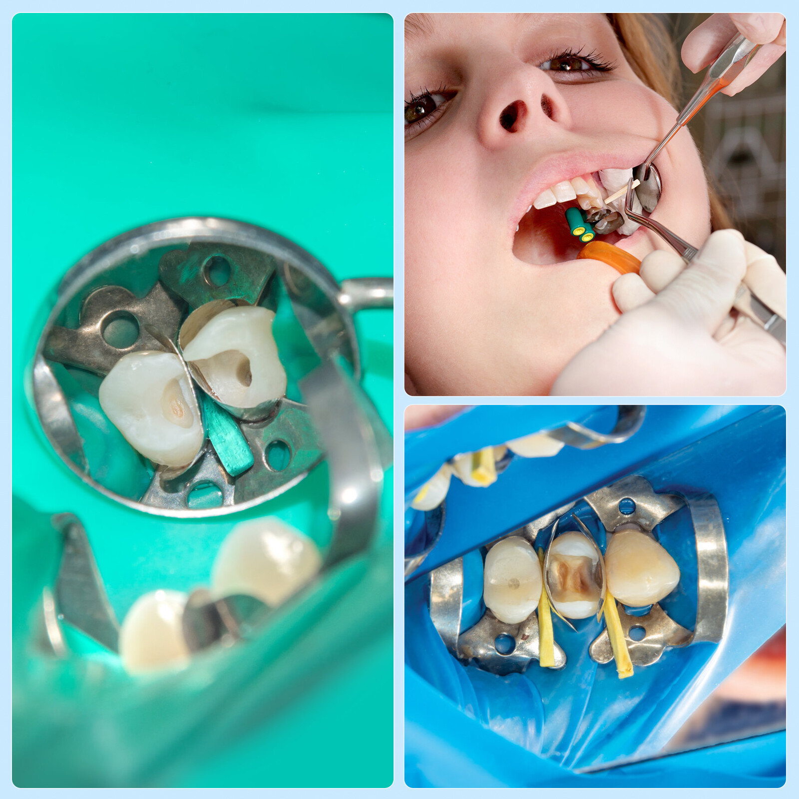 500PCS JMU Disposable Dental Colorful Wooden Wedges