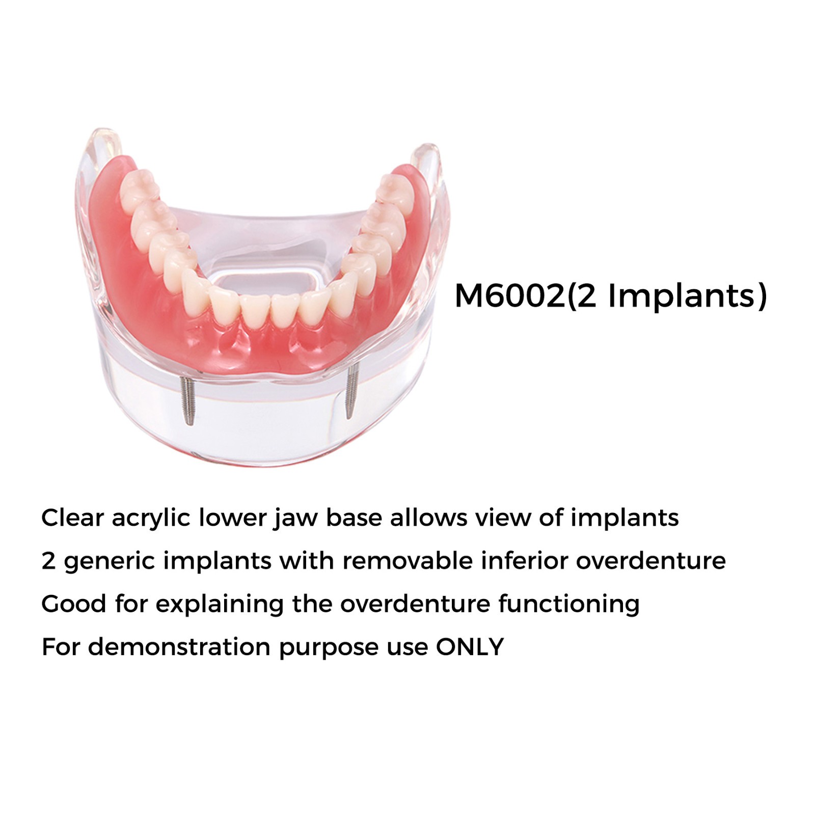 Dental Teeth Model 2 4 Implant Overdenture Typodont Restoration Demo Upper Lower