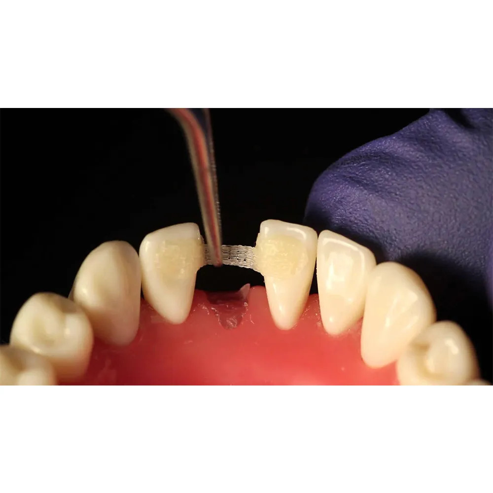 Ammdent Infibra BIOLOREN Light Cure Dental Glass Fiber Splint (Free Ship)