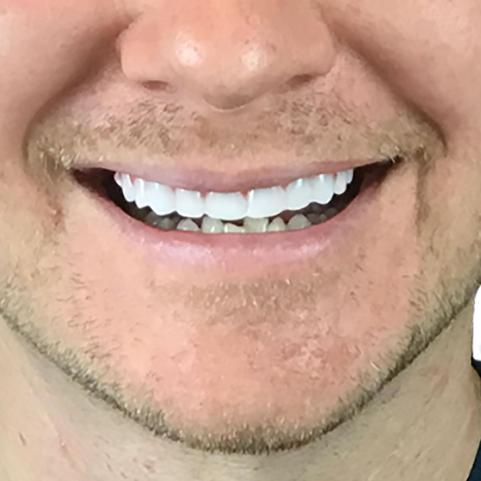 Instant Smile Comfort Fit Flex – Bright Shade – Upper 1 Count (Pack of 1)